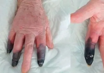 Koronavirüse yakalandı elleri bu hale geldi!