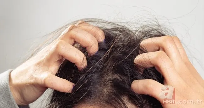 Egzamanızı tek 1 damlasıyla tarihe gömüyor! Saç kökünde kaşıntı, kepek, ağrı şikayetiniz varsa... 2