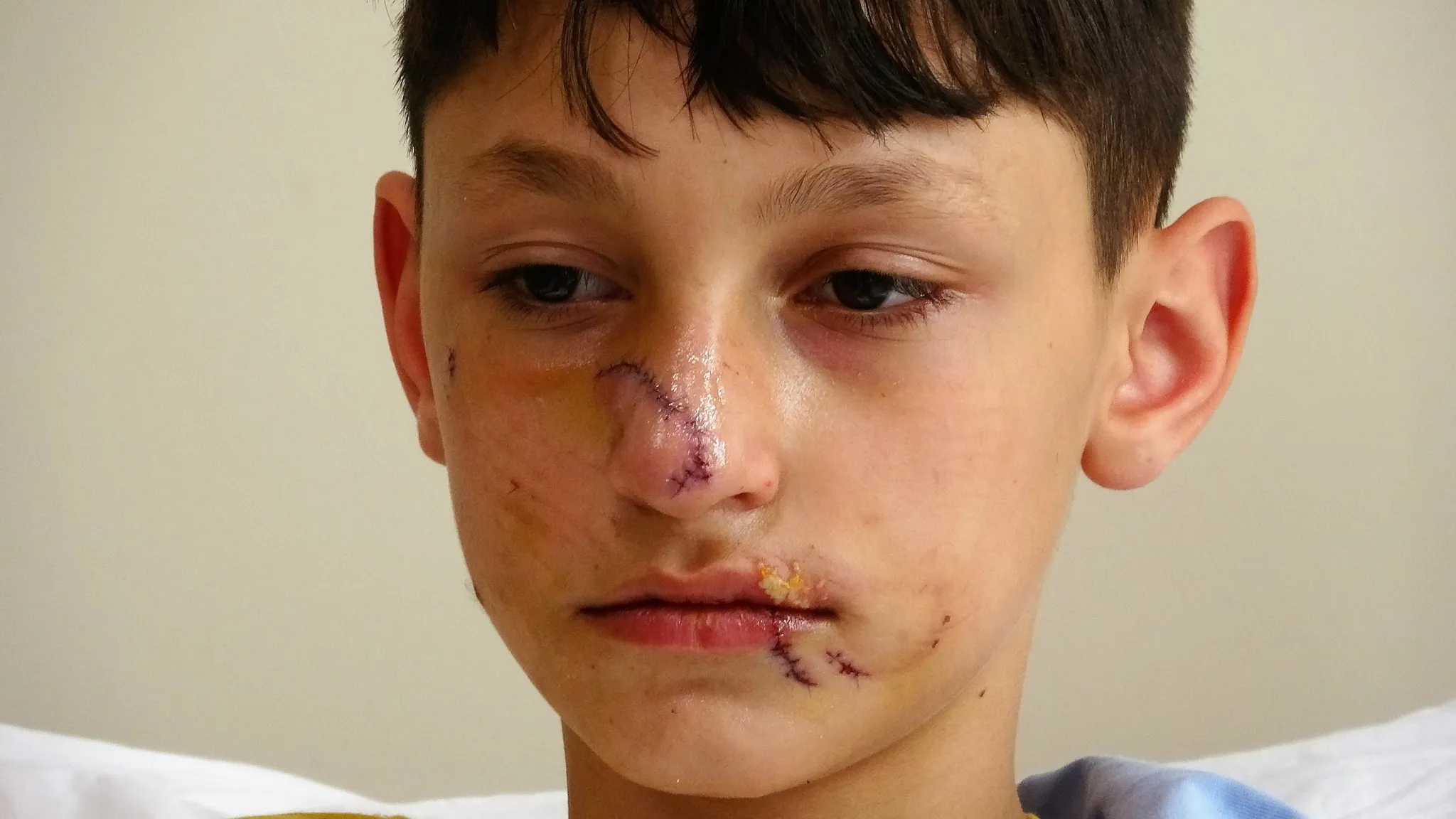 Minik Asiye gibi köpek saldırısı sonucu yaralanan Berat’tan güzel haber