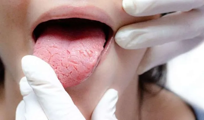 dil-renginize-dikkat-o-hastaligin-habercisi-olabilir-1726569157661.jpg Dil renginize dikkat! O hastalıkların habercisi olabilir... - 1