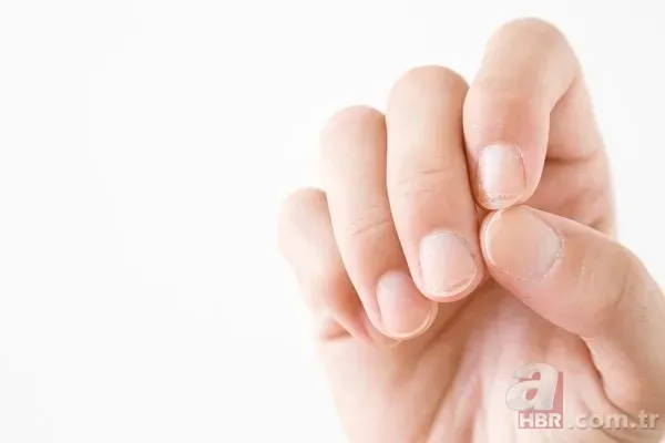 Tırnak diplerinizi kontrol edin! Belki de bu hastalıklardan birine sahipsiniz... 7