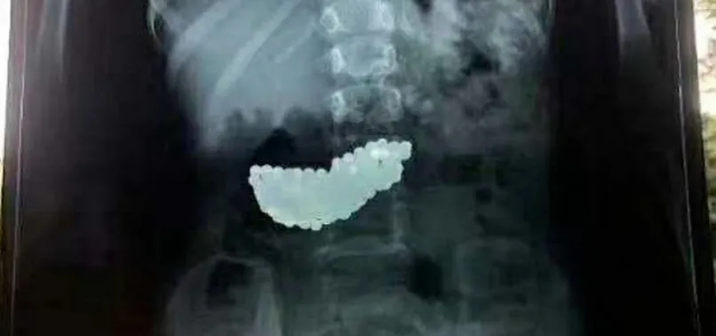 Röntgenle tespit edildi: 5 yaşındaki çocuk 2 ay böyle yaşadı!
