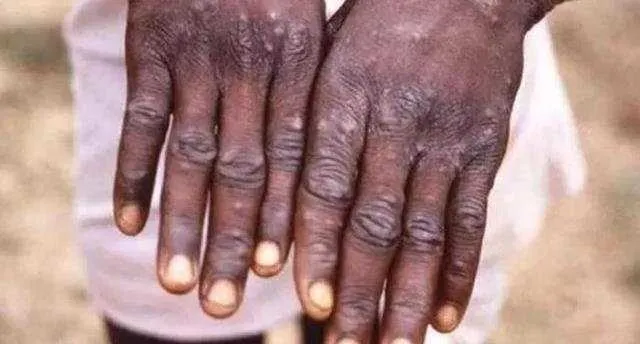 Maymun çiçeği virüsü için aşı geldi! DSÖ duyurdu: 2 doz vurulacak