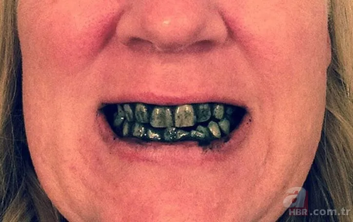 Diş beyazlatma yöntemleri işe yarıyor mu? 2