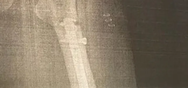 Uyluk kemiğindeki eğriliği düzeltmek için platin takılırken matkap kırılmış! Hayatı kabusa döndü - 2