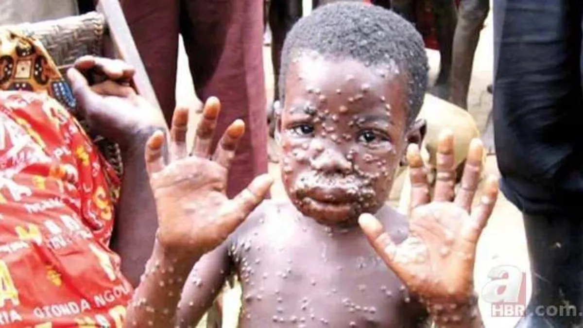 'Maymun çiçeği virüsü Sakarya'da görüldü' iddiası sonrası açıklama! İl Sağlık Müdürlüğü'nden yalanlama...