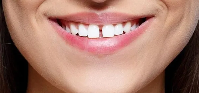 Aralıklı dişler sadece estetik bir sorun mu?