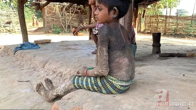 Vücudu her geçen gün taşa dönüşüyor! 5