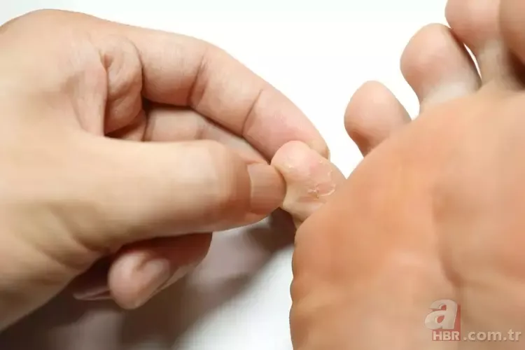 Ayak mantarını söküp atan yöntem! 10 dakikada pamuk gibi yapıyor 5