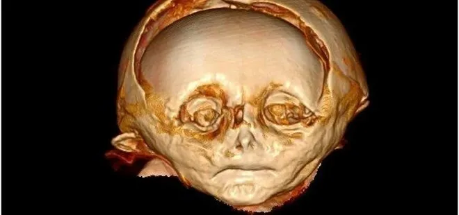 Avusturya’da mumyalanmış bebeğin sırrı çözüldü! Gerçek 400 yıl sonra ‘sanal otopsi’ sonucu ortaya çıktı