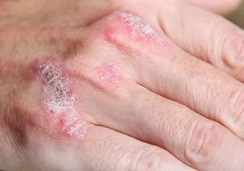 Cilt kuruluğu kanser habercisi olabilir