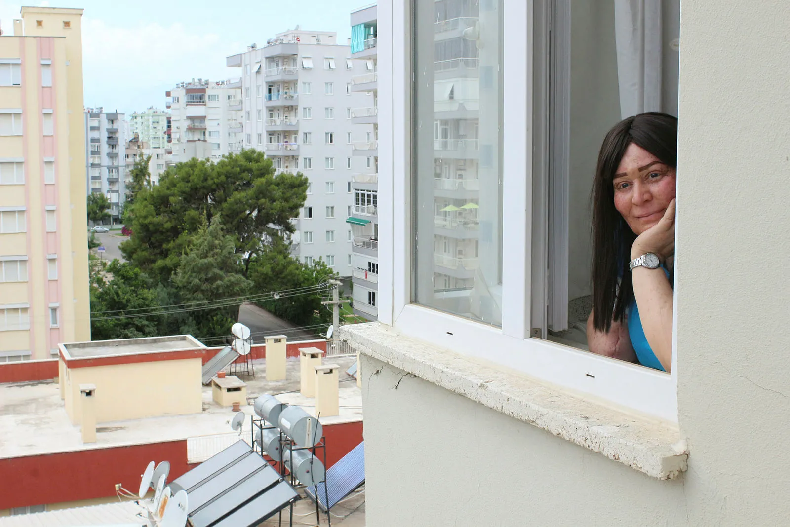 Güneşin erittiği kadın Sibel Oflas, yıllar sonra yüzünü yıkadı