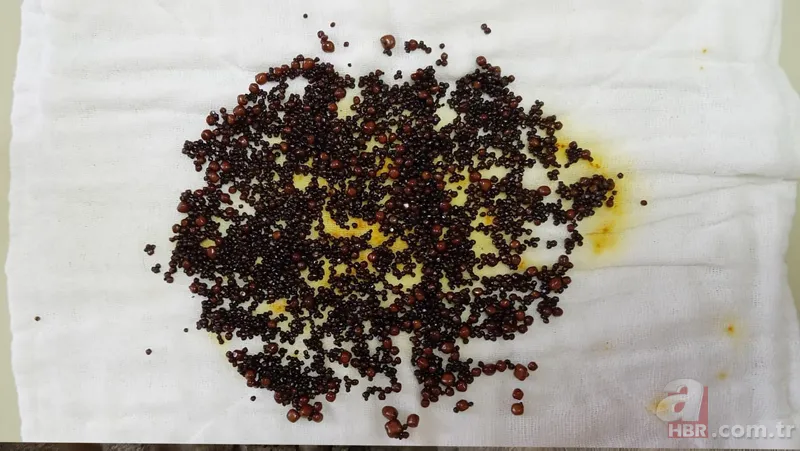 Karın ağrısı şikayetiyle gitti! Safra kesesinden çıkanlar doktorları bile şoke etti 5