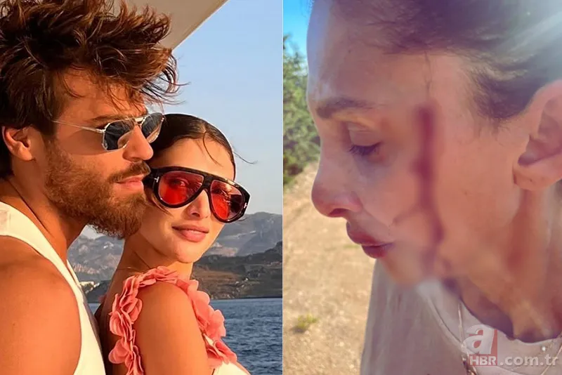 Can Yaman'ın şiddet gören sevgilisi kanlar içinde paylaştı! "Gerçekleri konuşma zamanı" 1