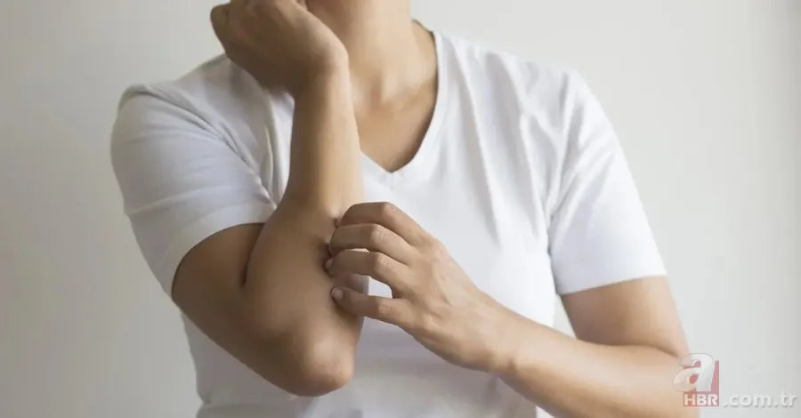 Uyuz hastalığı nedir, belirtileri neler? İnsandan insana uyuz nasıl geçer, kaşıntıya ne iyi gelir, tedavisi var mı? 7