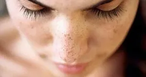 Güneşle gelen cilt lekelerine dikkat