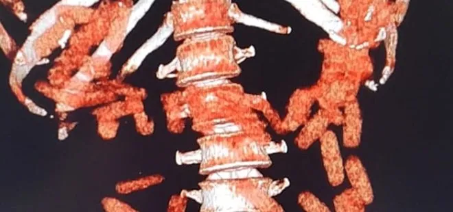 Kayseri'de hayrete düşüren olay! Midesinden çıkanlar şoke etti