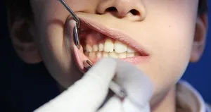 Yaz aylarında çocukların diş sağlığı için önemli uyarılar