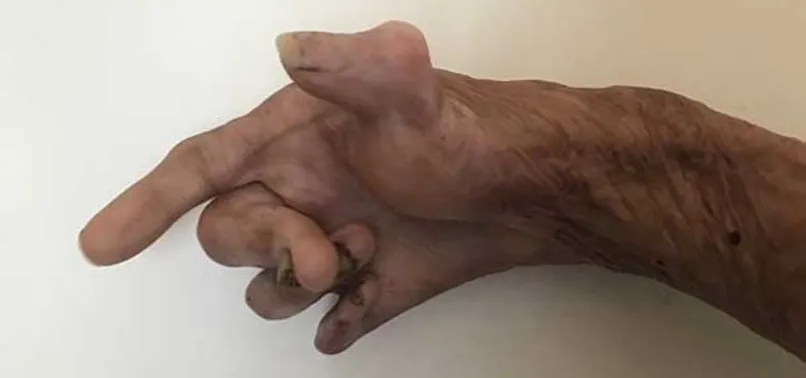 Sadece bir parmağı işlev görebilir halde