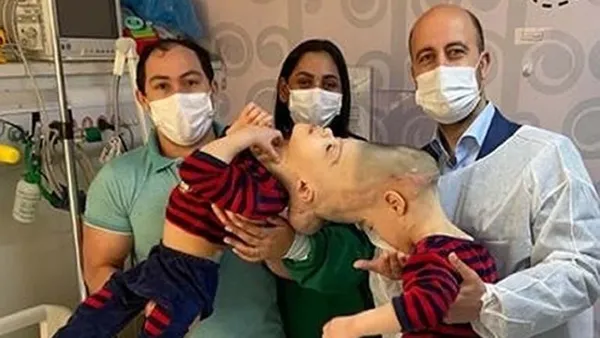 Tarihe geçen ameliyat: Yapışık ikizleri sanal gerçeklik ayırdı