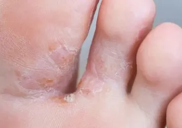 Mantar enfeksiyonuna dikkat! Uzmanından hayat kurtaran tavsiyeler