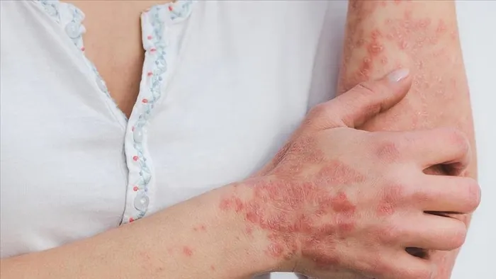 uzman-doktordan-sari-serum-uyarisi-hizla-iyilesmek-icin-sagliginizdan-olmayin-1738761705942.jpg Sarı serumun belirtileri arasında kızarıklık ve kaşıntı yer alıyor. (AA)