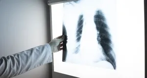 Akciğer kanserinde erken teşhis hayat kurtarıyor