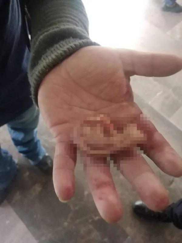 Metroda korkunç olay: Tartıştığı kişi kulağını ısırarak kopardı