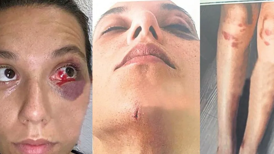 Ozan Güven'in darbettiği Deniz Bulutsuz'un yeni fotoğrafları dehşete düşürdü!