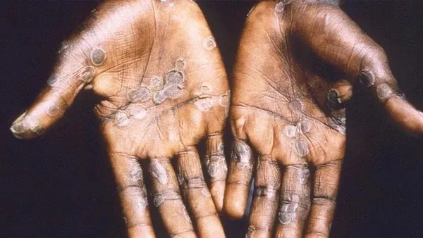 Türkiye’de maymun çiçeği vakası görüldü mü? Açıklama geldi