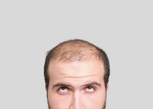 Saçı dökülenlere mucizevi çözüm