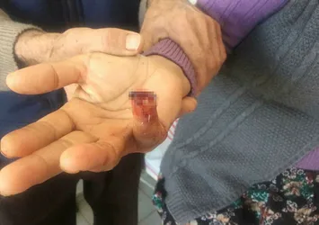 Komşusunun ısırıp kopardığı parmağını yuttu!