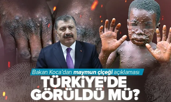 Son dakika: Maymun çiçeği salgını Türkiye’de görüldü mü? Sağlık Bakanı Fahrettin Koca açıkladı