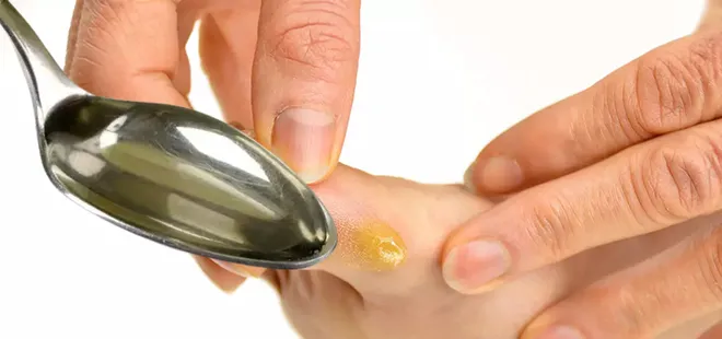 Mutlaka deneyin! 1 gecede yok olacak! Nasırı yerinden söküp atan yöntem...