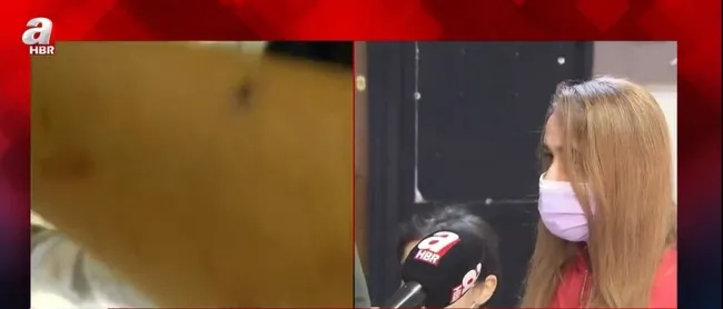 Beyin ameliyatı geçiren ve fabrikada darp edilen Enes Yağcı A Haber’e konuştu - 6