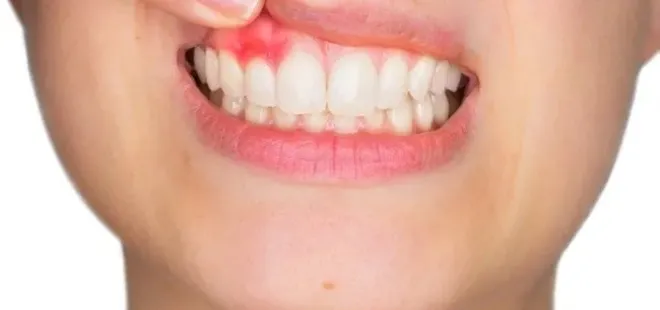 Bu hatalar diş minesine zarar veriyor! Sürekli atıştırıyorsanız...