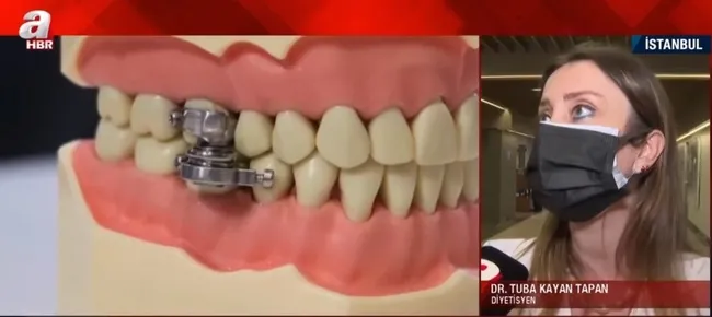 Obeziteye karşı yeni icat: Çene kilidi - 3