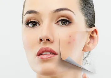 Çok antibiyotik ‘süper akne’ yaratıyor