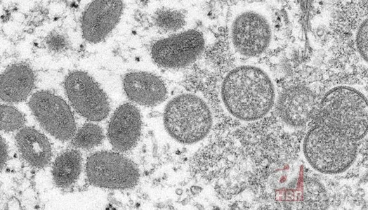 Maymun çiçek virüsü yeni salgına davetiye çıkardı! Avrupa’da vaka sayısı artışta, tedavisi yok 3