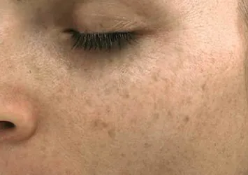 Güneş lekeleriyle mücadelede etkili yöntemler