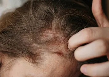 Egzama belirtileri nelerdir? Egzama nasıl geçer, ne iyi gelir?