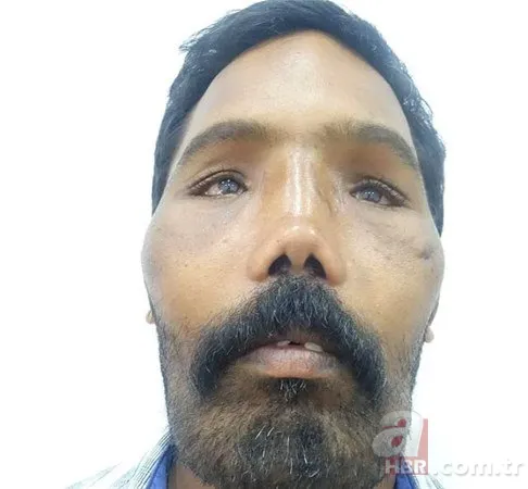 Dünyanın en tuhaf hastalıkları 3