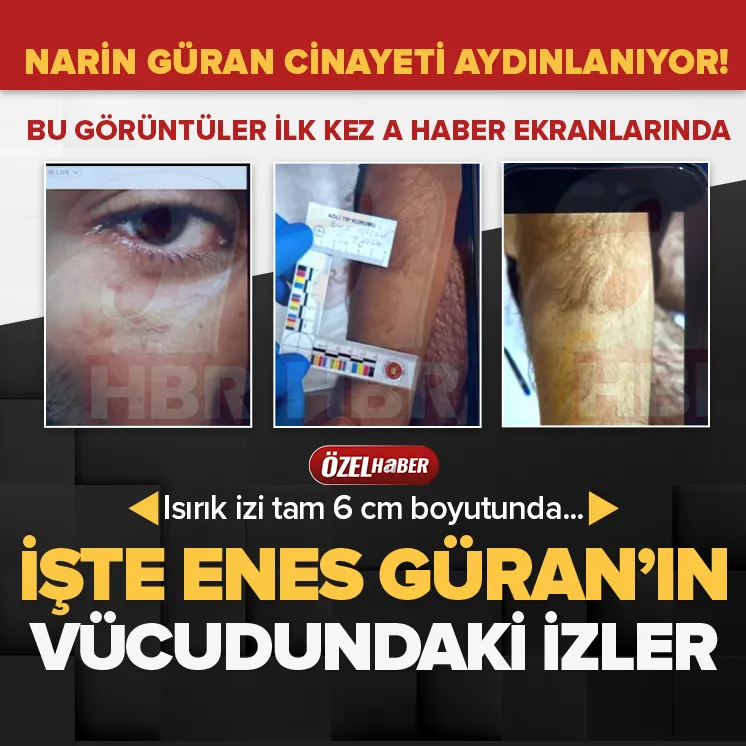 Enes Güran’ın vücudundaki izler ilk kez A Haber’de!