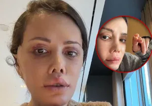 Yüz nakli sonrası ilginç gelişme! Didem Ceran'ın kaşında saç çıktı
