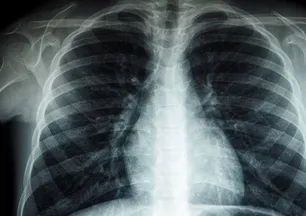 Tıp dünyasını şaşırtan gelişme! Bir hasta akciğerleri olmadan iki gün hayatta kaldı