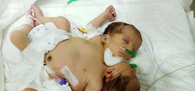 Afrinli yapışık ikizler Hatay’a getirildi