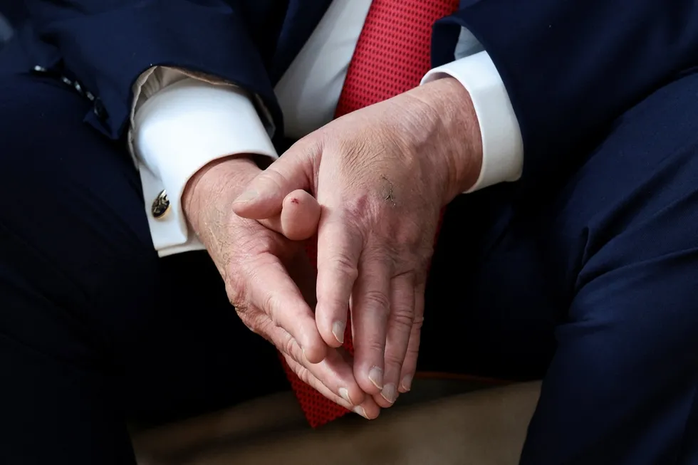 ABD Başkanı Donald Trump'ın elindeki morluk ve yara izleri dikkat çekiyor. (AFP)