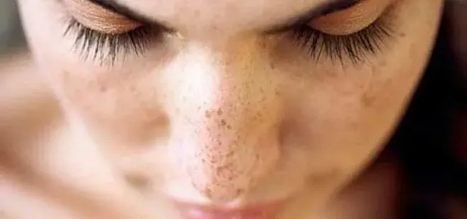 Güneşle gelen cilt lekelerine dikkat