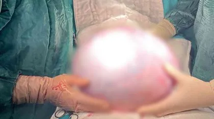 Giderek kilo almaya başladı soluğu doktorda aldı! Karnından çıkanı görünce gözlerine inanamadı 👨⚕️ Ameliyat sonrası 9 kilo zayıfladı