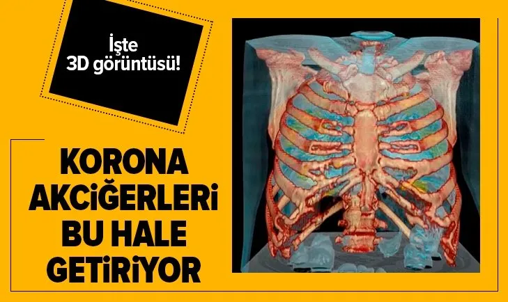 Corona virüs Covid-19 akciğerleri bu hale getiriyor! İşte koronavirüslü akciğerin 3D görüntüsü
